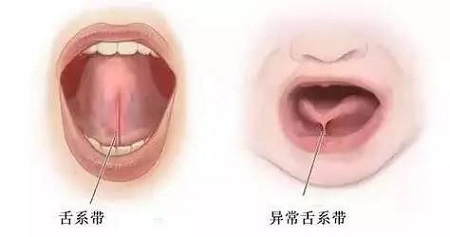 舌系帶過長影響孩子發(fā)音,嚴(yán)重不會說話